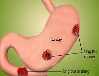 Người Việt ăn uống ‘chung đụng’ dễ nhiễm khuẩn gây ung thư dạ dày