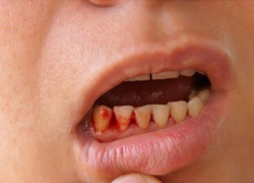 Nhật Bản phòng trị bệnh răng lợi bằng kháng thể Igy