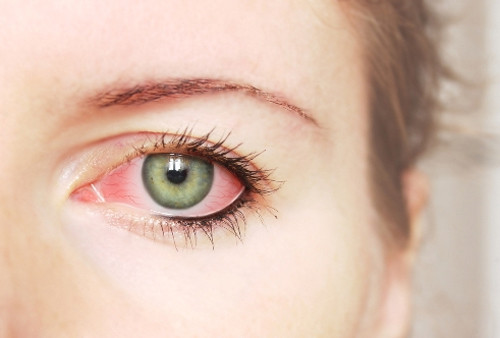 Làm thế nào để phòng bệnh đau mắt đỏ ?