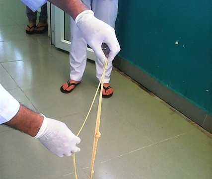 Quảng Nam: ‘Giải cứu’ bệnh nhân mắc sán xơ mít dài…10 mét