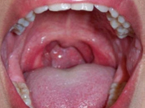 Cẩn thận với những triệu chứng của ung thư vòm họng