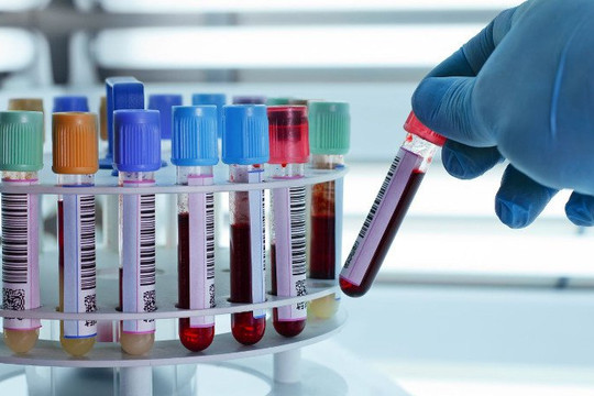 Xét nghiệm máu giúp chẩn đoán sớm ung thư tuyến tụy