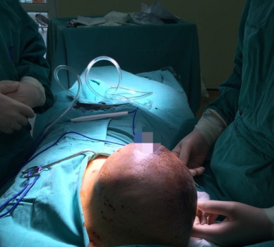 Bệnh viện K phẫu thuật thành công khối u tuyến vú khổng lồ