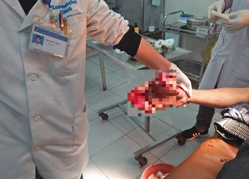 Phẫu thuật thành công cho bệnh nhân bị dập bàn tay do nổ bình gas mini