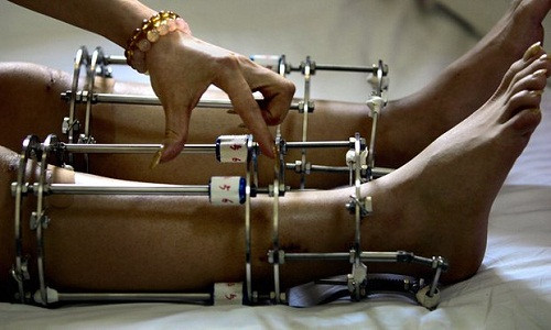 Ca phẫu thuật kéo dài chân kỷ lục ở Việt Nam: Sau 100 ngày cao thêm 10cm