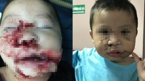 Bé trai 2 tuổi bị chó cắn nát mặt đã được phẫu thuật tạo hình