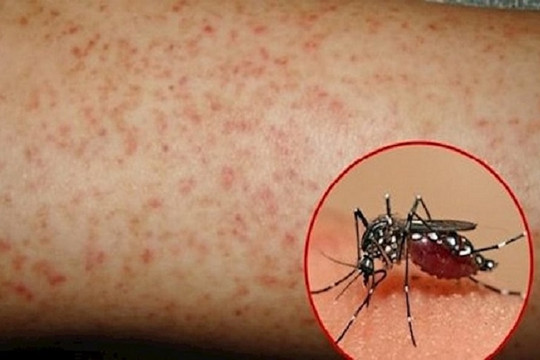 Dịch bệnh sốt xuất huyết vào mùa: Không chủ quan, lơ là