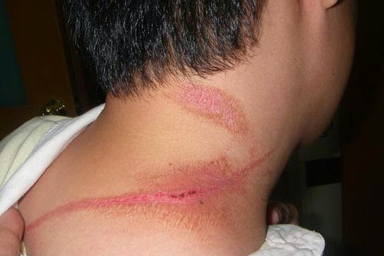 Nam thanh niên nhập viện vì chữa bệnh bằng cách gã kiến ba khoang đắp lên da