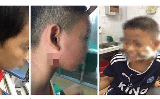 Phát hiện 3 ca trẻ em Nghệ An bị vi khuẩn ‘ăn thịt người’ tấn công