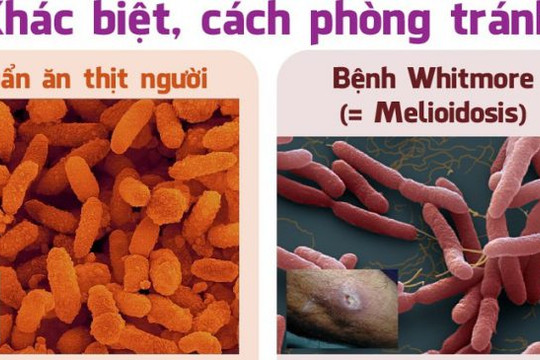 [Infographic] Phân biệt bệnh do ‘vi khuẩn ăn thịt người’ và bệnh whitmore