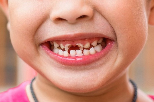 90% người Việt bị bệnh răng miệng