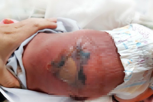 Em bé sơ sinh bỏng nặng, nhiễm trùng máu do nằm than