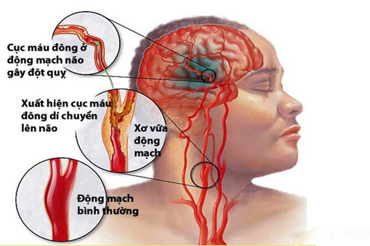 Cảnh báo nhồi máu não chiếm tỷ lệ khoảng 80-85% đột quỵ não