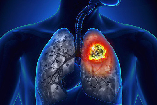 Israel phát triển phương pháp chữa trị ung thư bằng cách “làm sạch” phổi