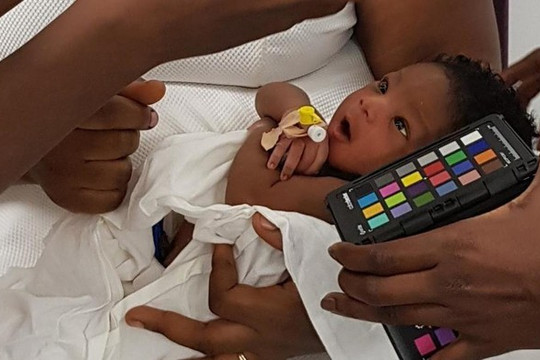 Chẩn đoán chính xác bệnh vàng da ở trẻ sơ sinh qua ứng dụng điện thoại thông minh