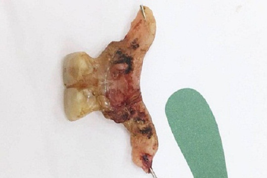 TP. HCM: Suýt thủng ruột vì vô ý nuốt răng giả hơn 2 tháng