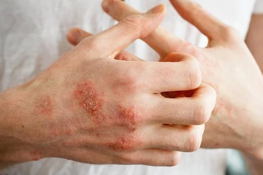 Nước ô nhiễm: Thủ phạm gây bệnh da liễu tiềm ẩn