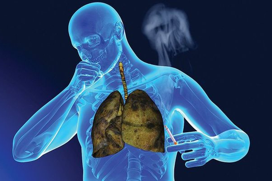 Nghiên cứu mới: Ô nhiễm không khí có thể gây đột biến DNA dẫn đến ung thư phổi ở người không hút thuốc