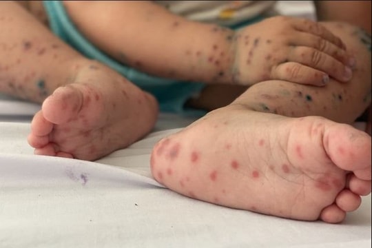 TP Huế: Số trẻ mắc bệnh tay chân miệng tăng nhanh